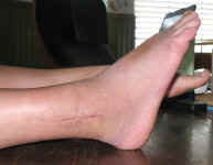 foot-plantarflexion.jpg (38039 bytes)