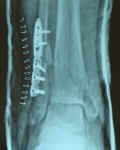 post-surgery-xray.jpg (35337 bytes)